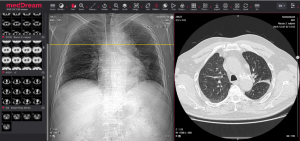 Pneumonia Ct Covid19 Lungs Meddream Dicom Viewer